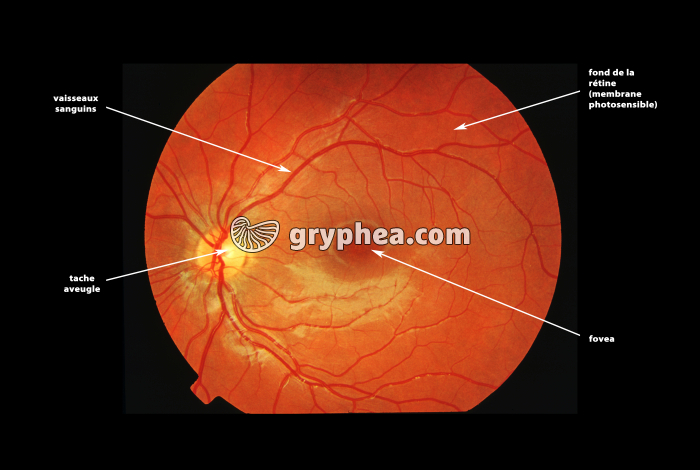 Fond de rétine d'un enfant de 12 ans (vue légendée) - gryphea.org